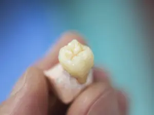 牙周病 5 牙周病治療費用ptt熱門問題解析,一次看懂牙周病治療
