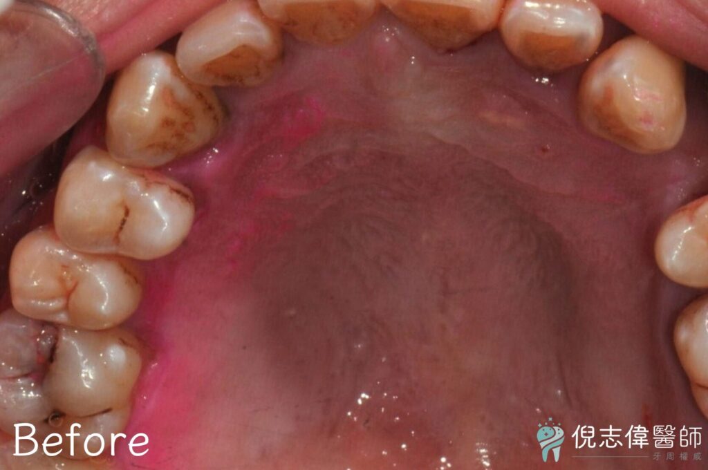 陳先生牙周治療前1