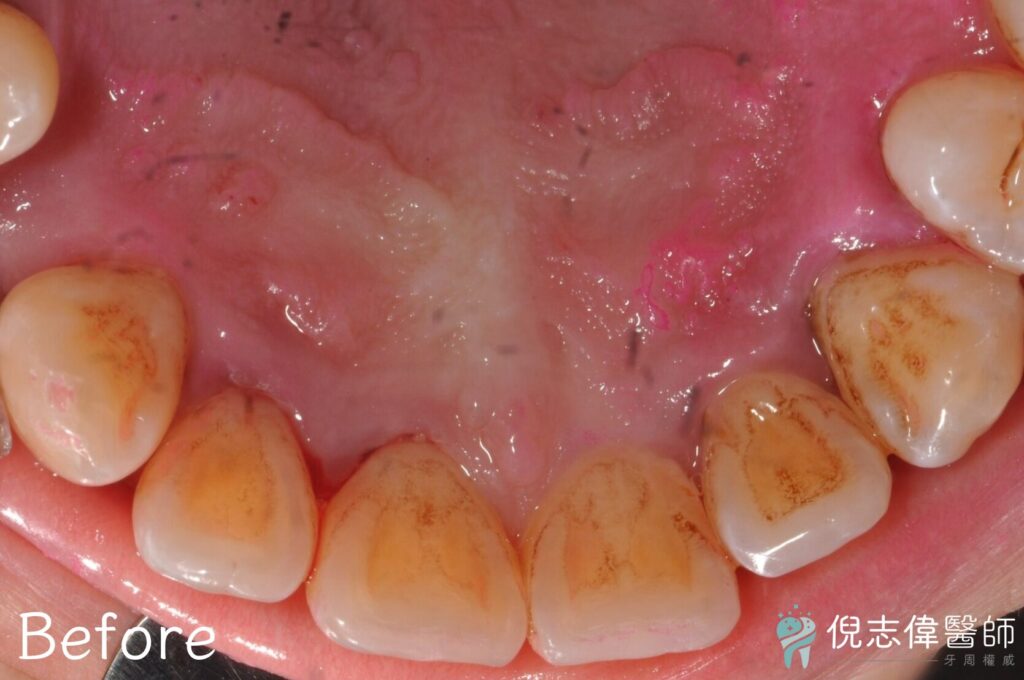 陳先生牙周治療前5