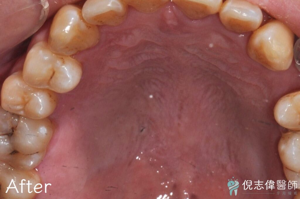 陳先生牙周治療後1