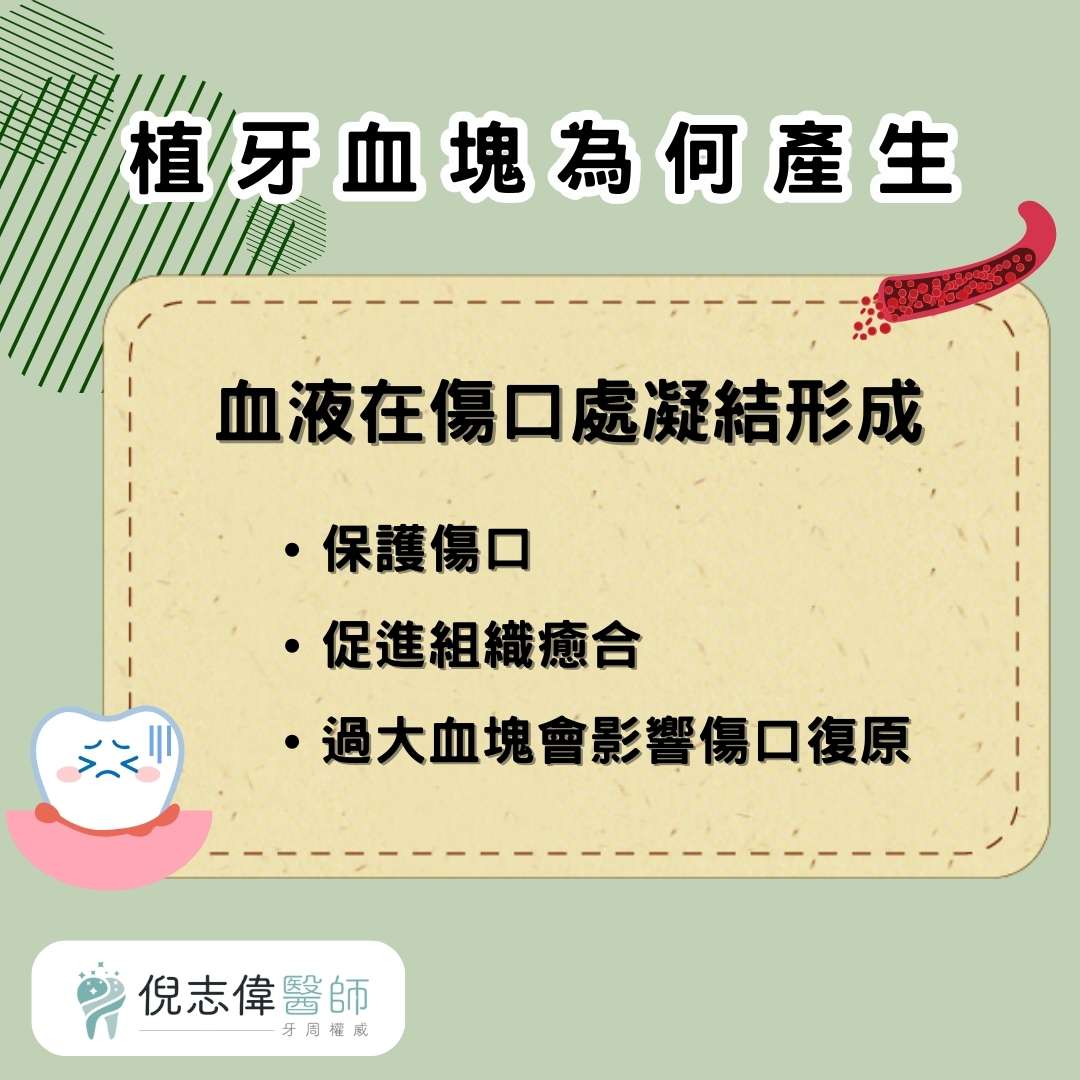 植牙血塊、流血不止、傷口裂開怎麼處理?醫師說明植牙後常見的併發症 1 植牙血塊為何產生