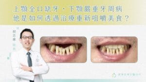 台南牙周病專科|倪志偉醫師 5 上顎全口缺牙,下顎嚴重牙周病,他是如何治療重新咀嚼美食?01