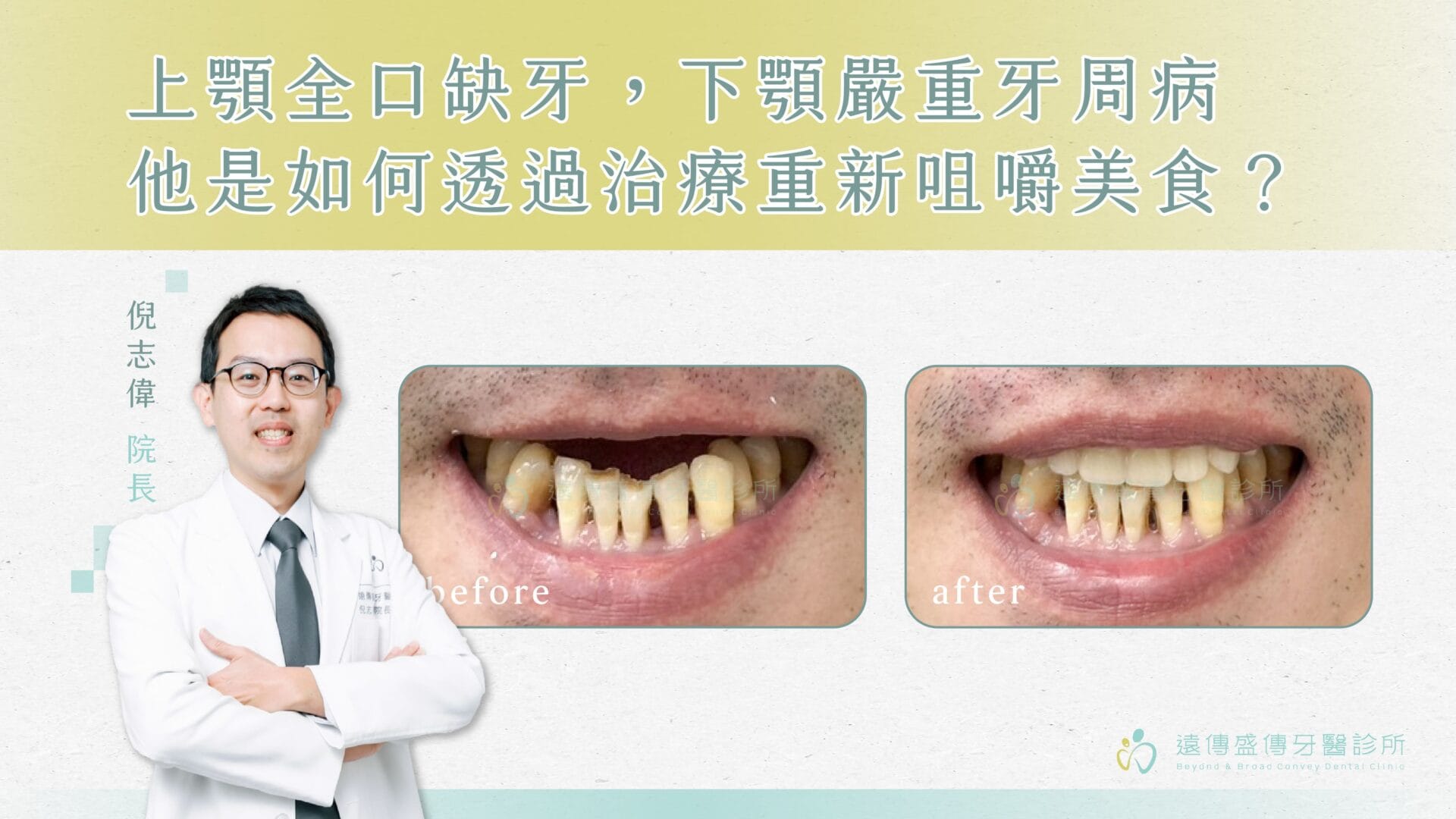 上顎全口缺牙，下顎嚴重牙周病，他是如何治療重新咀嚼美食？01