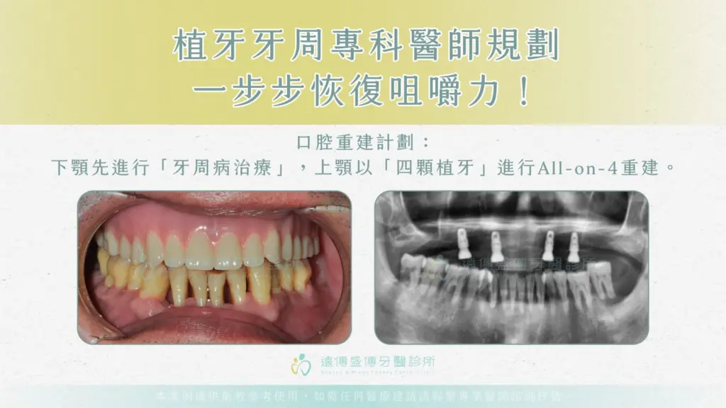 上顎全口缺牙，下顎嚴重牙周病，他是如何治療重新咀嚼美食？03