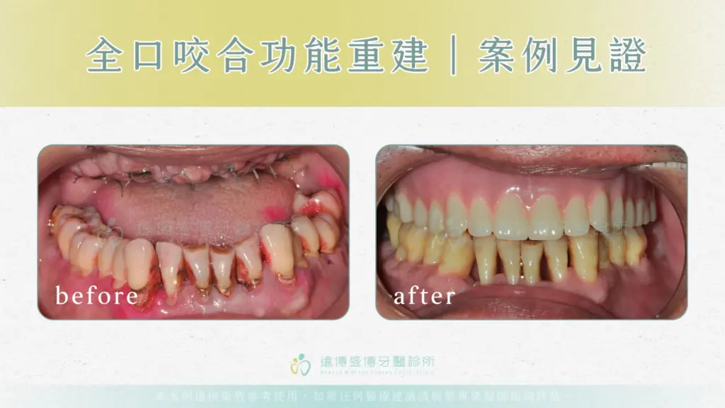 上顎全口缺牙，下顎嚴重牙周病，他是如何治療重新咀嚼美食？04