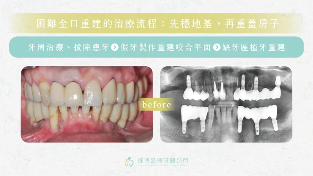 缺牙多年也能重建？從牙周治療到植牙補骨，如何恢復穩定咬合？3