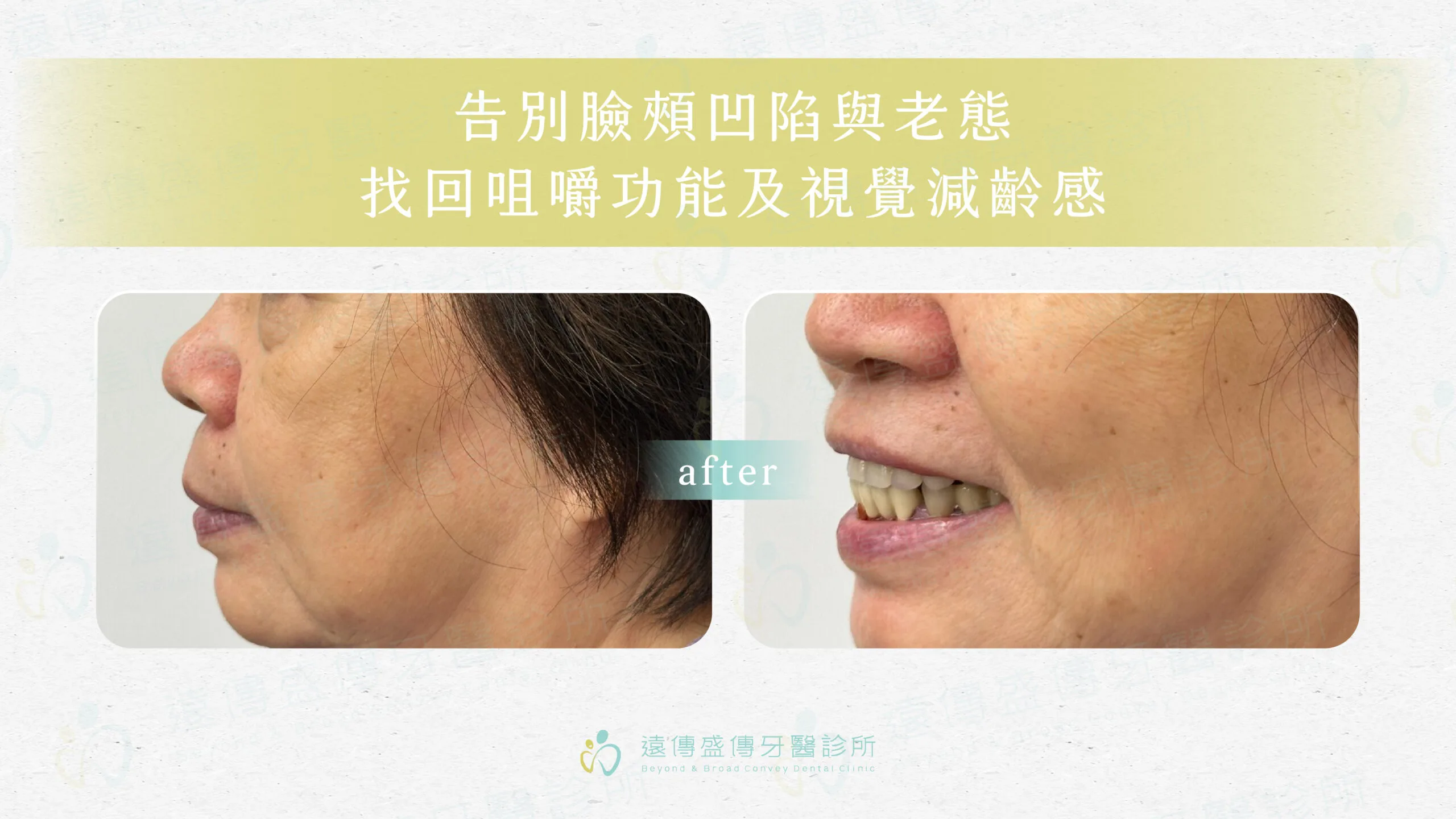 告別臉頰凹陷與老態，找回咀嚼功能及視覺減齡感