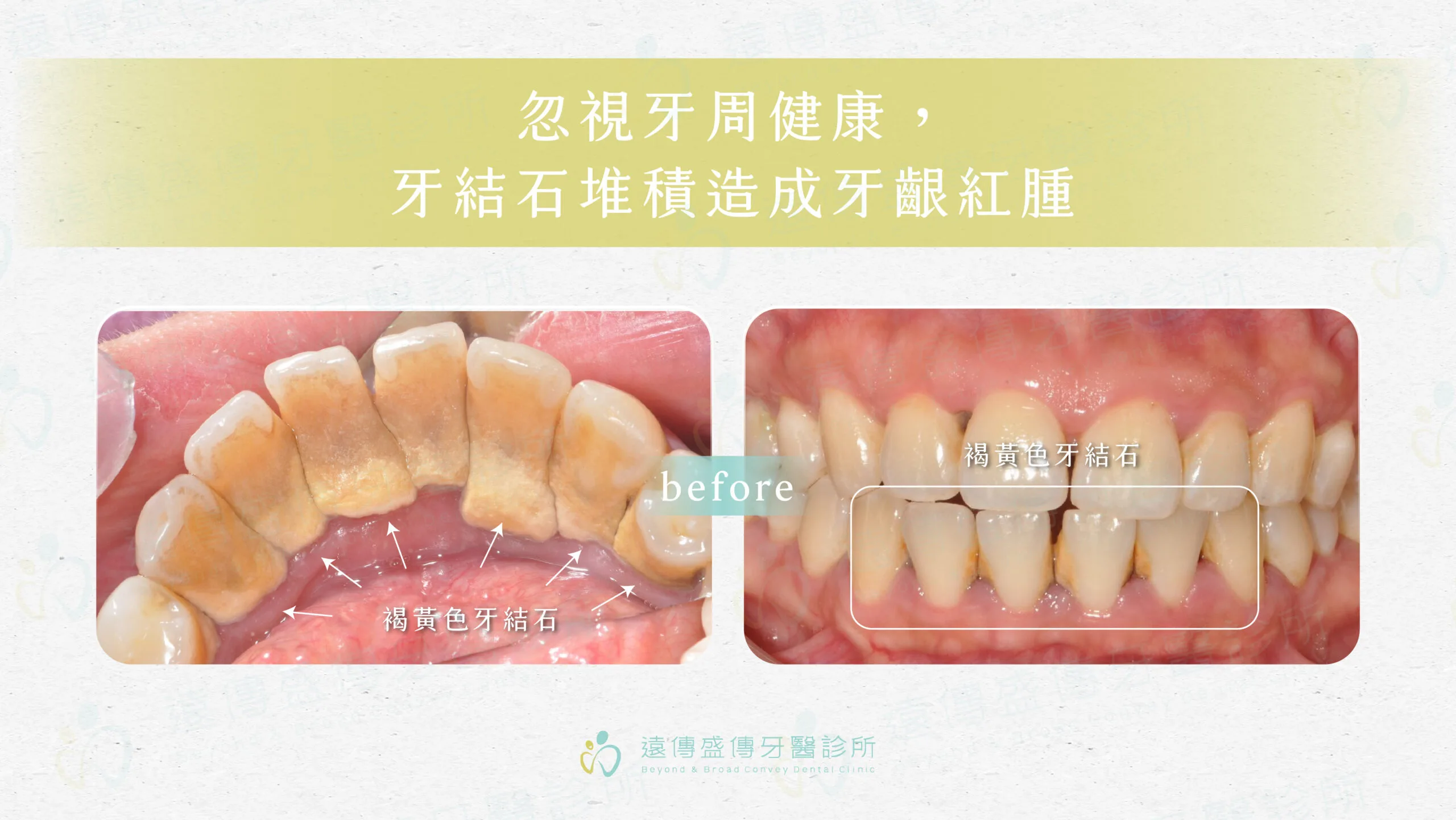 忽視牙周健康，牙結石堆積造成牙齦紅腫-1