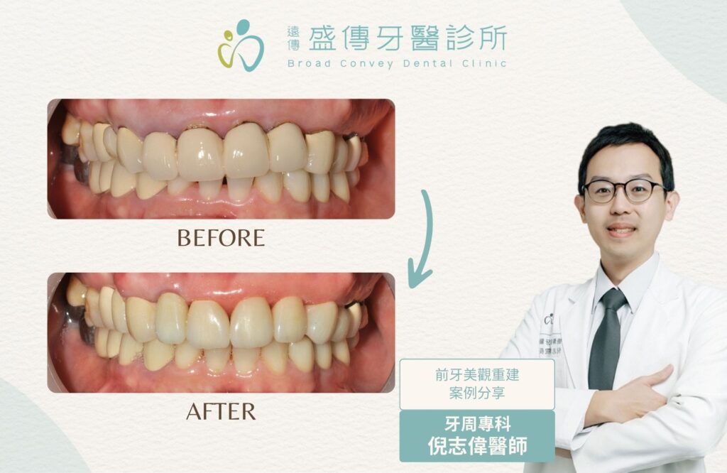 anterior teeth aesthetic case d