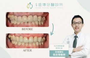 anterior teeth aesthetic case d