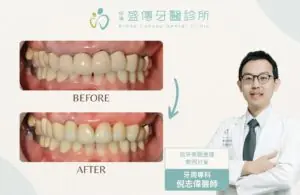 成功案例 10 anterior teeth aesthetic case d