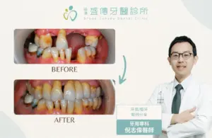 台南牙周病專科|倪志偉醫師 6 case 18 03 1