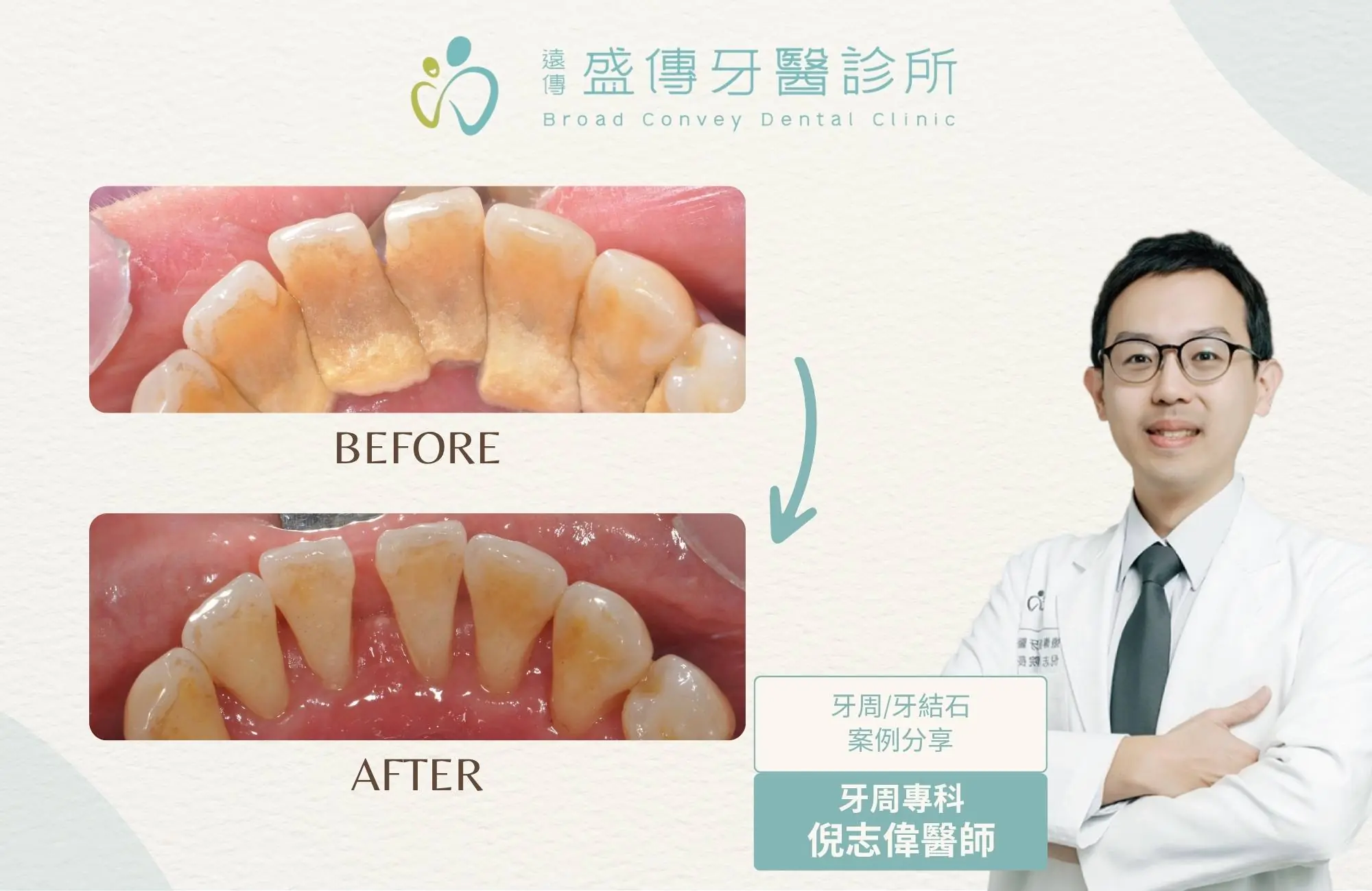 牙結石清潔