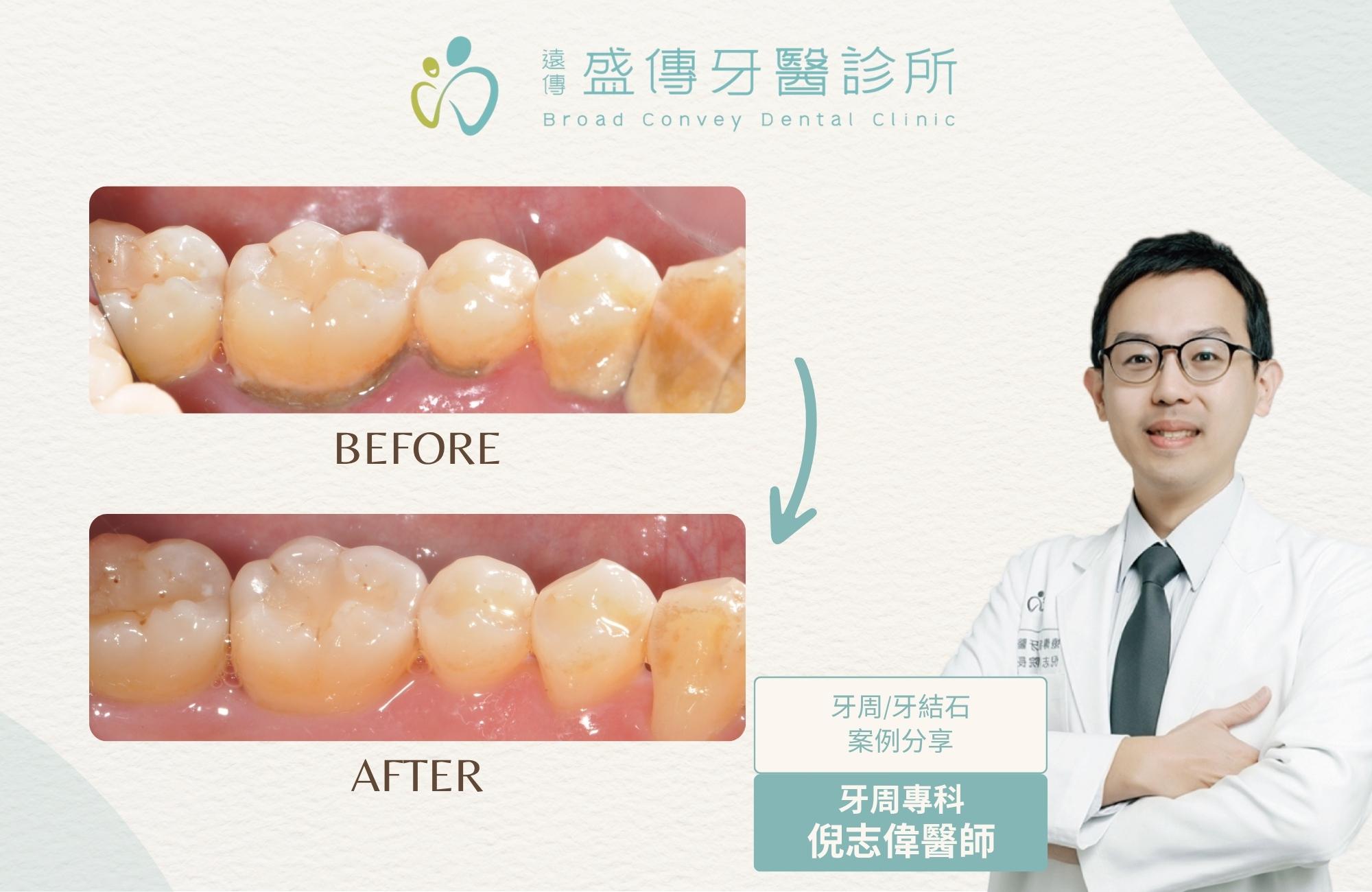 牙周清潔