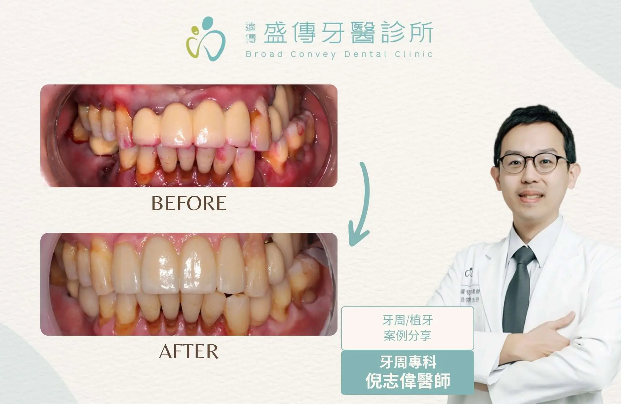 牙周病牙齦