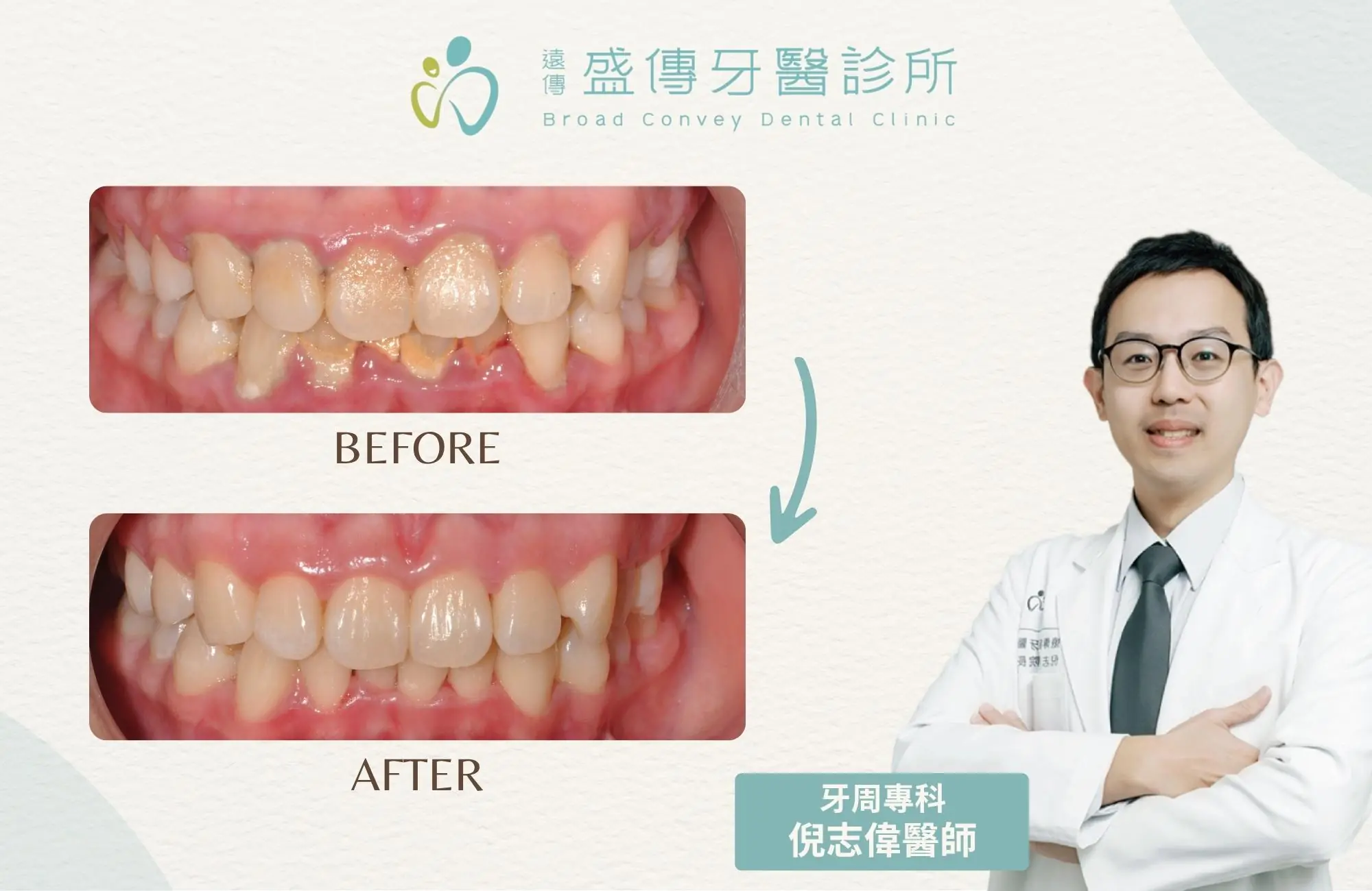 牙周病發炎牙結石導致按壓疼痛，經倪志偉醫師牙周專科治療後牙齦恢復健康前後對比