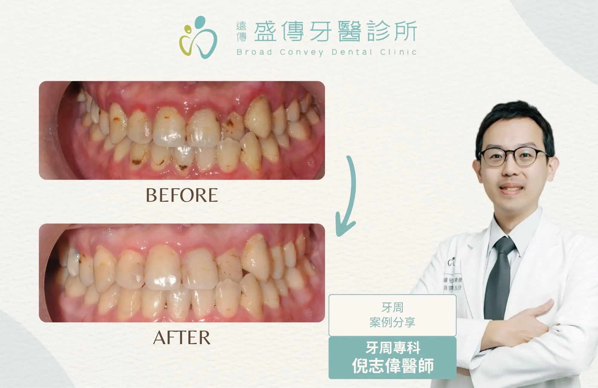 牙齦腫痛
