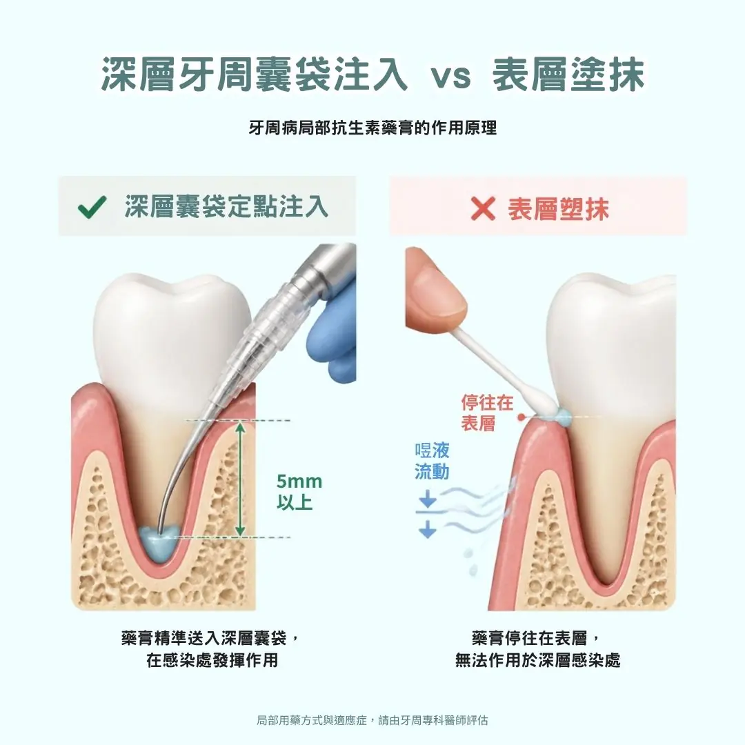 牙周病治療藥膏（Periocline）正確使用方式：於牙周囊袋內局部緩慢釋放殺菌藥效圖解