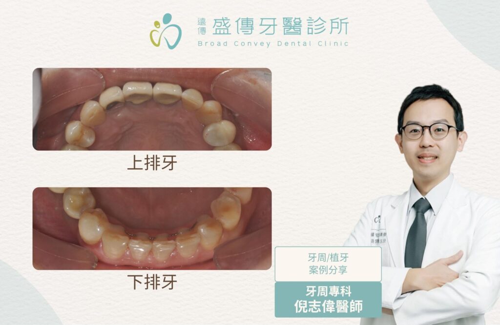 posterior missing teeth periodontal orthodontic implant case 01