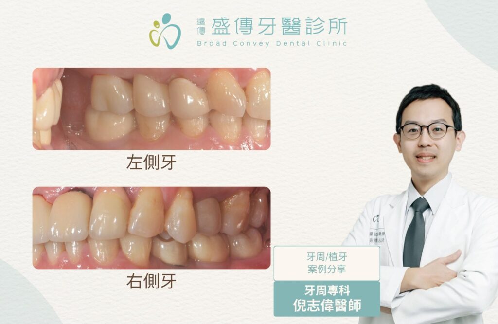 posterior missing teeth periodontal orthodontic implant case 02