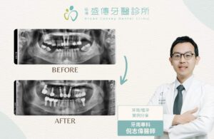 posterior missing teeth periodontal orthodontic implant case 03