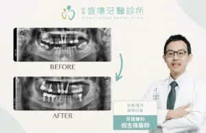台南牙周病專科|倪志偉醫師 5 posterior missing teeth periodontal orthodontic implant case 03