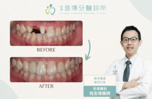 台南牙周病專科|倪志偉醫師 5 case 32 02