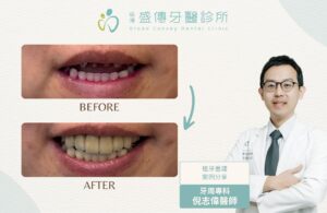 台南牙周病專科|倪志偉醫師 5 牙周病植牙案例_34_C小姐