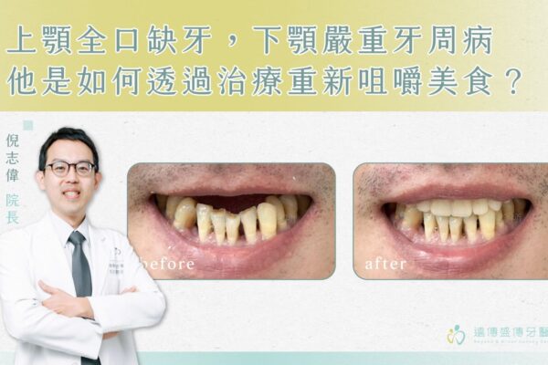 上顎全口缺牙，下顎嚴重牙周病，他是如何治療重新咀嚼美食？01