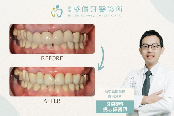 前牙美學案例_22_K小姐