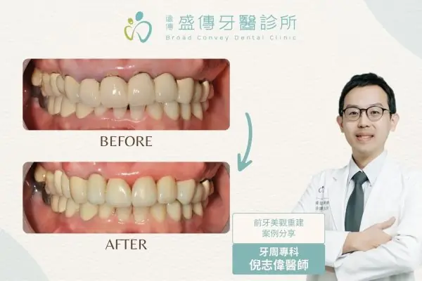 前牙美學案例_22_K小姐