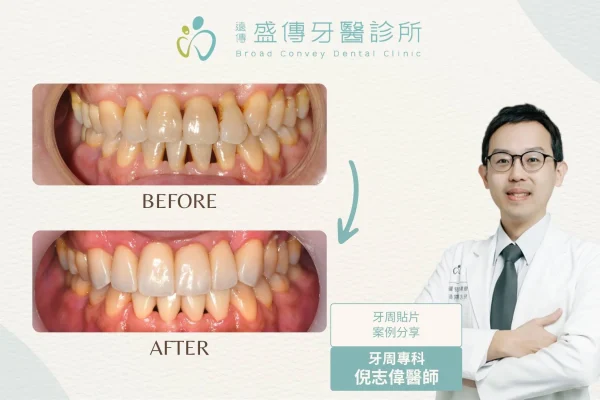 牙周貼片案例_16_J先生
