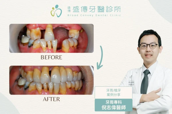 牙周植牙案例_19_H小姐