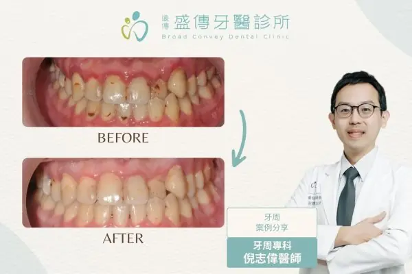 牙周治療案例_24_Y先生